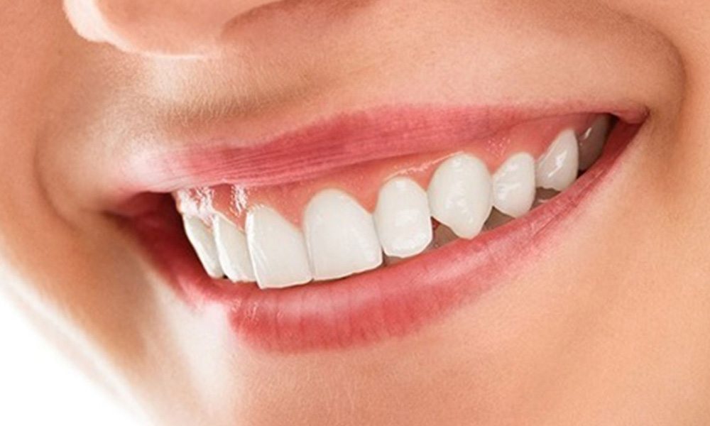 Veneers: Unveiling the Science Behind Your Perfect Smile